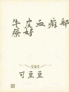 牛皮血癣哪里治疗好