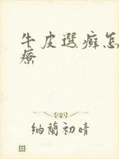 牛皮选癣怎么治疗