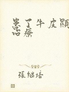 患了牛皮显怎么治疗