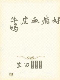 牛皮血癣好治疗吗