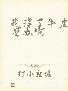 我得了牛皮该怎么办啊