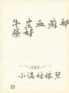 牛皮血癣哪里治疗好