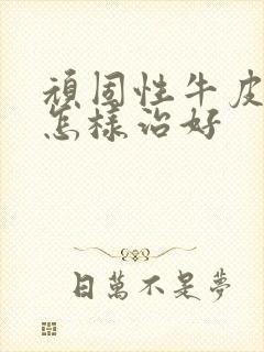 顽固性牛皮有癣怎样治好