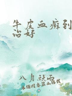 牛皮血癣到哪里治好