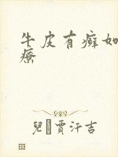 牛皮有癣如何治疗