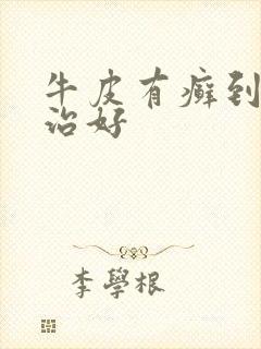 牛皮有癣到哪里治好