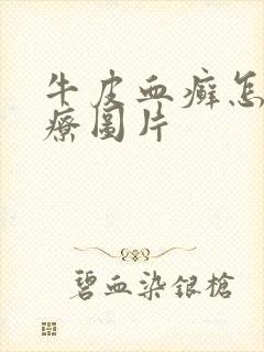 牛皮血癣怎么治疗图片