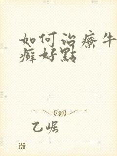 如何治疗牛皮有癣好点