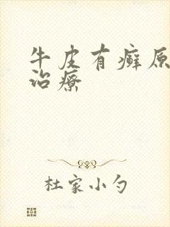 牛皮有癣原因及治疗