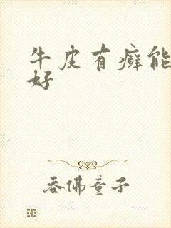 牛皮有癣能治疗好