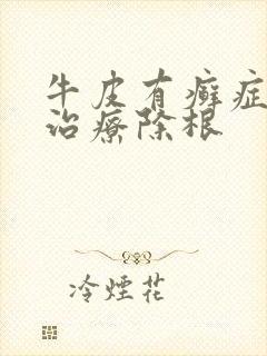 牛皮有癣症怎么治疗除根