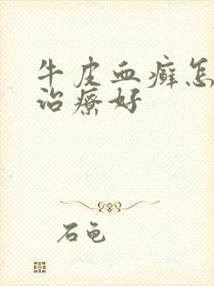 牛皮血癣怎么能治疗好