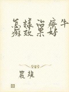 怎样治疗牛皮血癣效果好