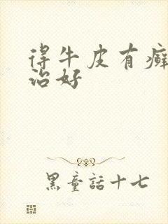 得牛皮有癣如何治好