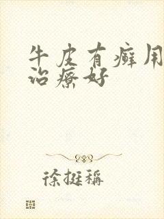 牛皮有癣用什么治疗好