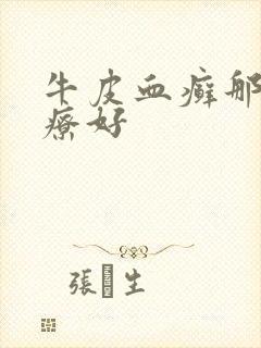 牛皮血癣那里治疗好