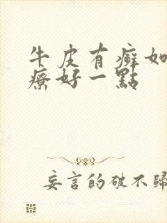 牛皮有癣如何治疗好一点