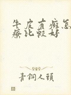 牛皮有癣怎样治疗比较好