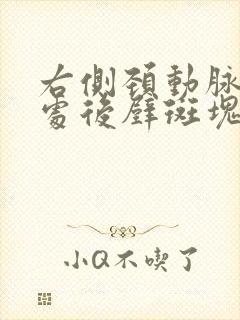 右侧颈动脉分叉处后壁斑块