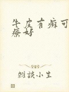 牛皮有癣可以治疗好