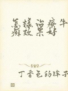 怎样治疗牛皮血癣效果好