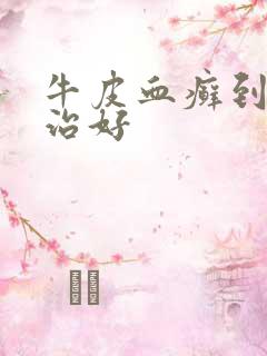 牛皮血癣到哪里治好