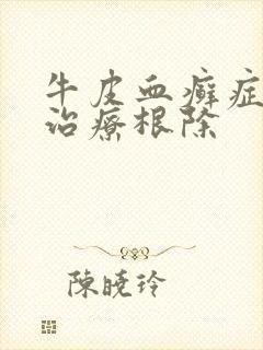 牛皮血癣症怎么治疗根除