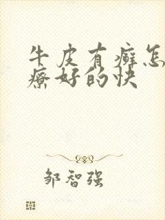 牛皮有癣怎么治疗好的快