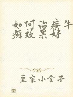 如何治疗牛皮有癣效果好