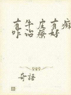 有牛皮有癣需要咋治疗好