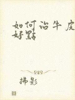 如何治牛皮有癣好点