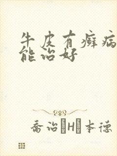 牛皮有癣病怎么能治好