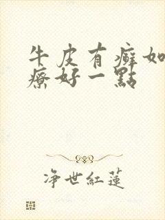 牛皮有癣如何治疗好一点