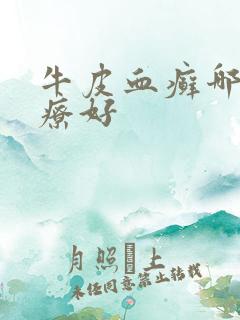 牛皮血癣哪里治疗好