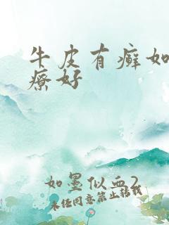 牛皮有癣如何治疗好