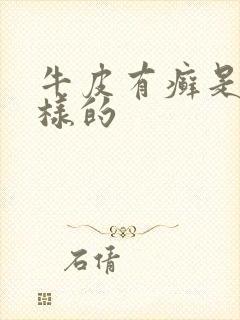 牛皮有癣是怎么样的