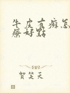 牛皮有癣怎么治疗好点