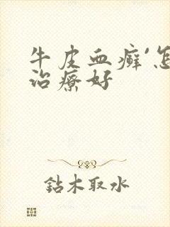 牛皮血癣`怎么治疗好