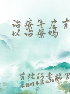 治疗牛皮有癣可以治疗吗