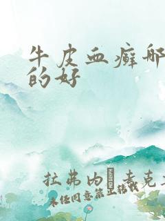 牛皮血癣哪里治的好