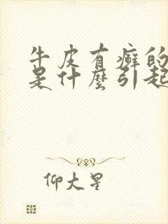 牛皮有癣的原因是什么引起的