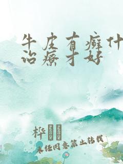 牛皮有癣什么药治疗才好