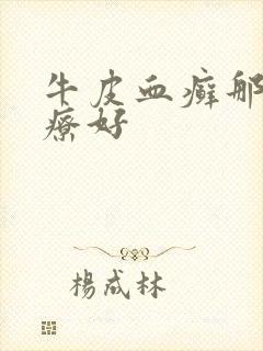 牛皮血癣那里治疗好