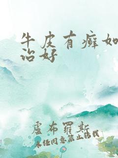 牛皮有癣如何能治好