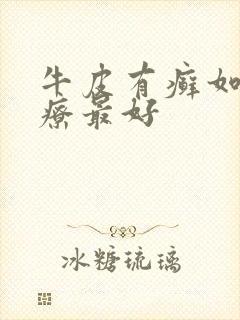 牛皮有癣如何治疗最好