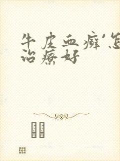 牛皮血癣`怎么治疗好