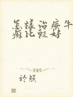 怎样治疗牛皮有癣比较好