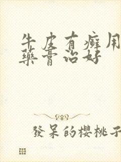 牛皮有癣用什么药膏治好