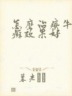 怎么治疗牛皮有癣效果好