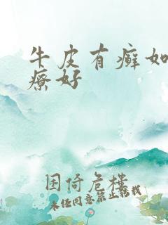 牛皮有癣如何治疗好